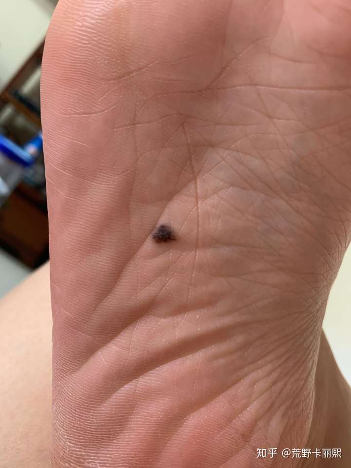 手术切脚底痣是怎么样的体验?