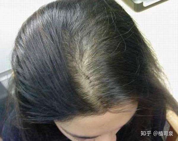 油脂性脱发怎么治疗最好女性快速生发的方法 知乎