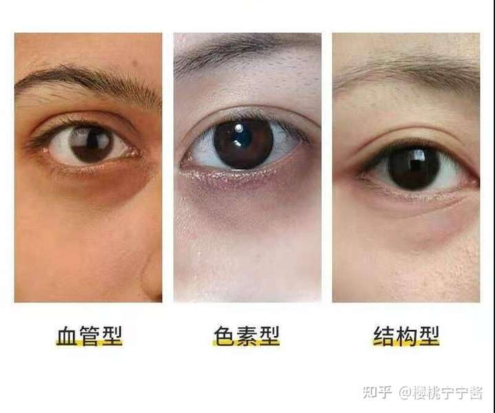 为什么不熬夜作息健康还是有特别重的黑眼圈?