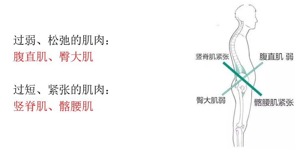 75 85 人有骨盆前倾 您还不自知 快点检测下严重程度和学习下改善方法吧 知乎