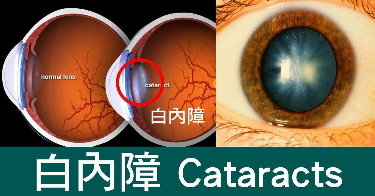 人过50岁都要警惕它 致盲率最高的凶手竟没人能逃过 知乎