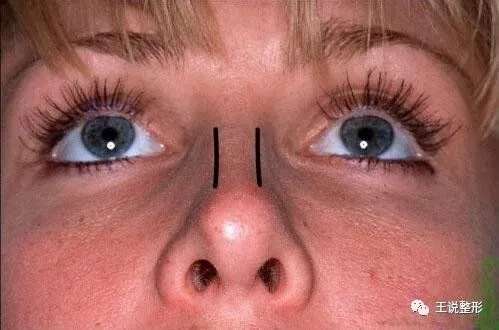 鼻基骨缩窄术 为什么我鼻梁明明很高 正脸看却像条鱼 知乎