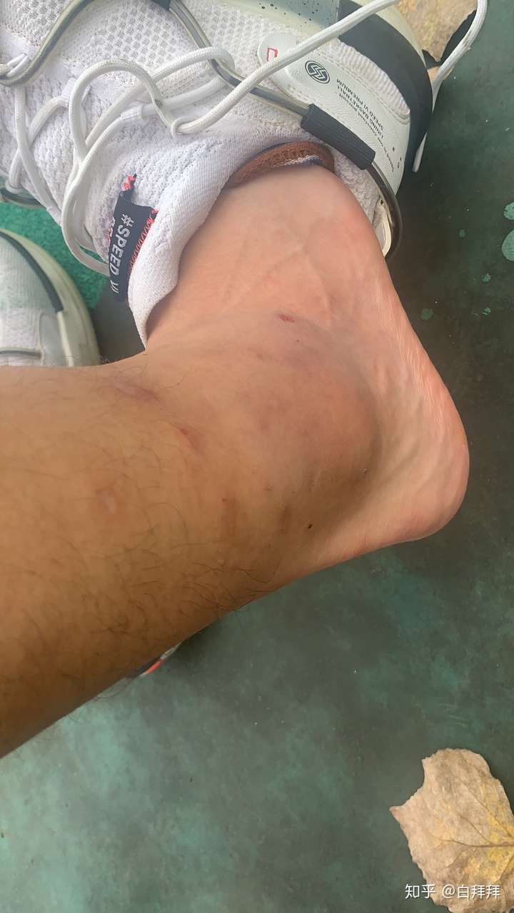 右脚踝韧带断裂跟腓断裂治疗记录ni