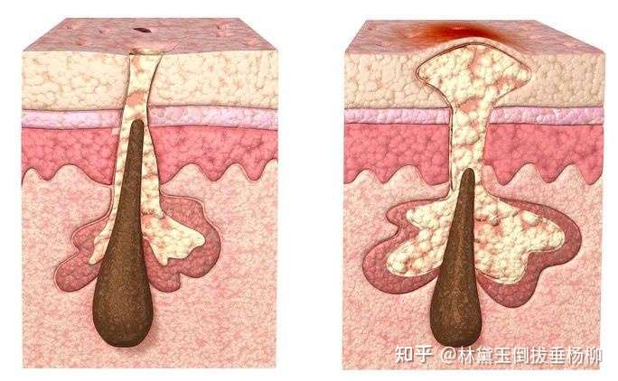 我們的皮膚是需要皮脂腺分泌油脂來保護自己的,可由於生理期,作息