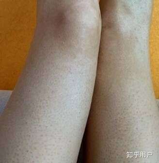 健身可以去皮肤鸡皮(身体去鸡皮哪种效果好)