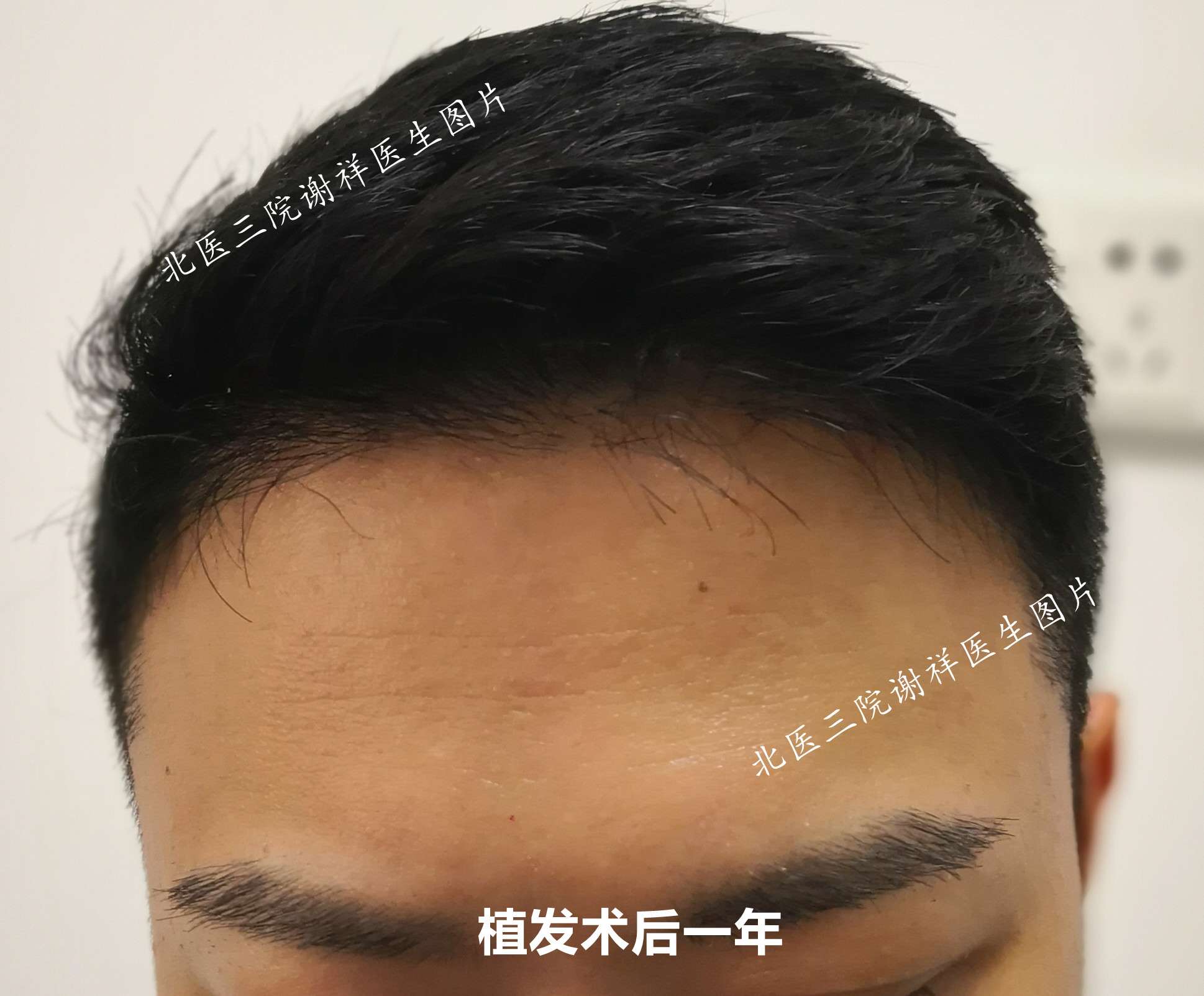 植发哪能学(植发学校哪个比较好)