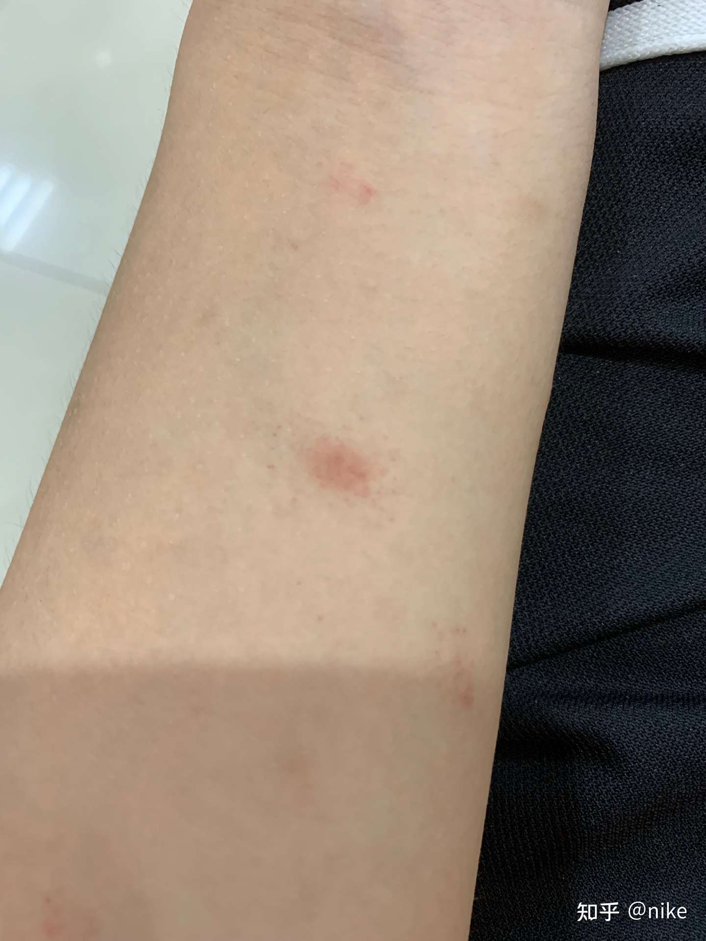 皮下出血 条状红斑 不痛不痒 知乎