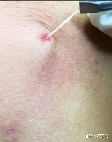 什么是羊毛疔 - 知乎