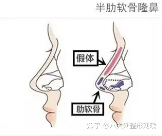 北京隆鼻科普肋软骨鼻综合中全肋隆鼻和半肋隆鼻该如何选择