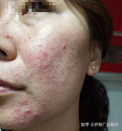 维a酸乳膏第一次用多了导致全脸发红怎么办怎么消除