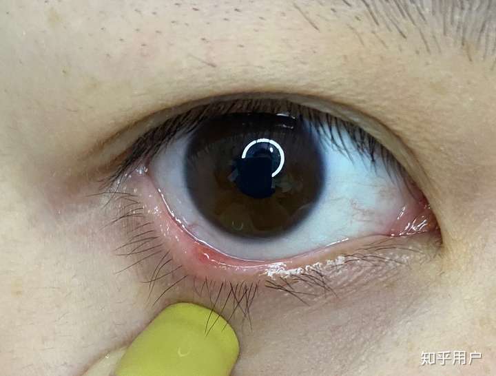 眼睑炎初期症状图片图片