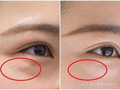 如何看待一个25岁女的鱼尾纹?