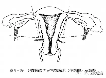 子宫全切示意图图片