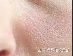 毛孔