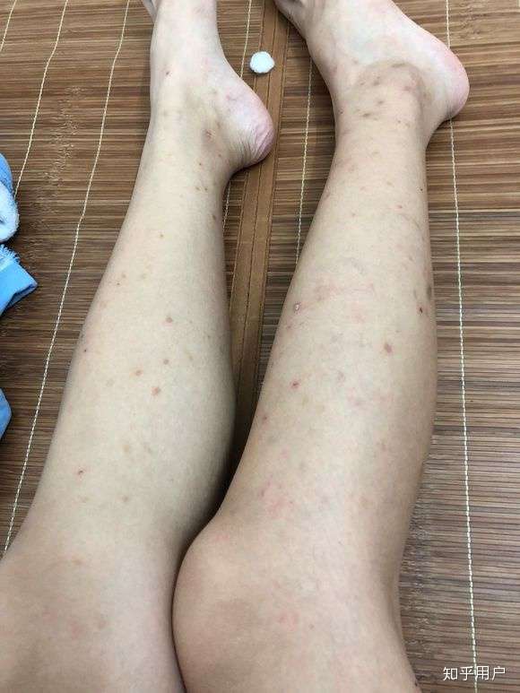 被蚊子咬了留下的疤怎么去除