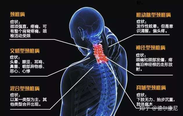 颈椎病引起的头晕 怎么治疗最有效 知乎