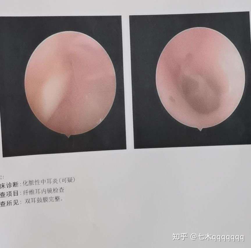 慢性 化脓性中耳炎 鼓膜大穿孔一年自愈经历 知乎