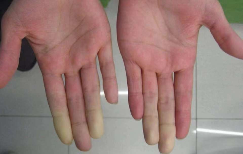 风湿科张春艳 的想法: 冬天手脚发白,是受冻了吗?