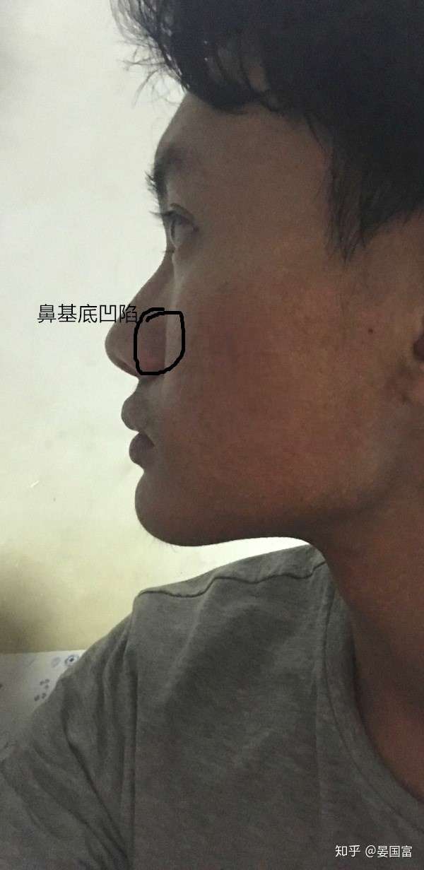 感觉鼻子两侧凹的 我这种是面中部凹陷吗 孩怎么改善?