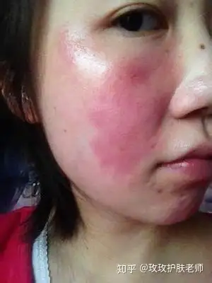 化妆品过敏用过药膏之后脸发红痒干裂怎么办是不是激素脸