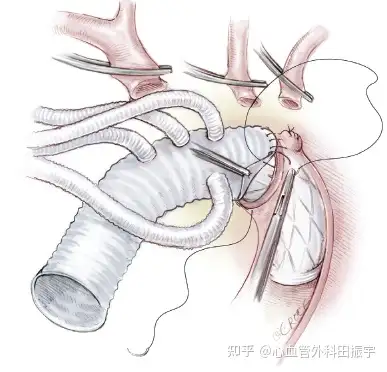 主动脉夹层的分型