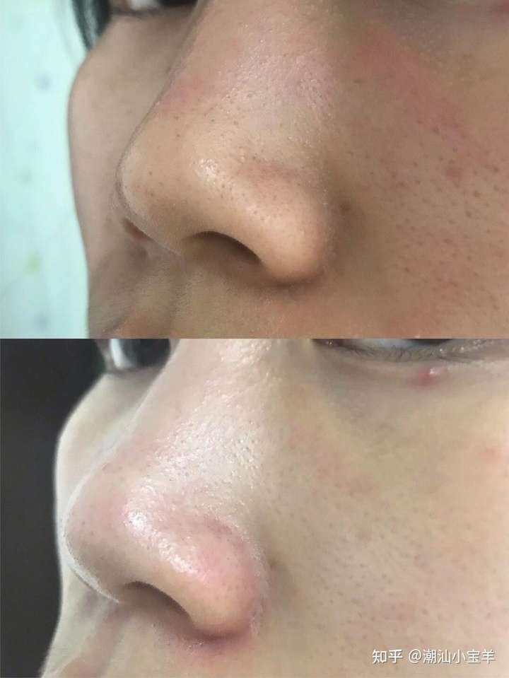 真诚求哪个去黑头粉刺好的产品?