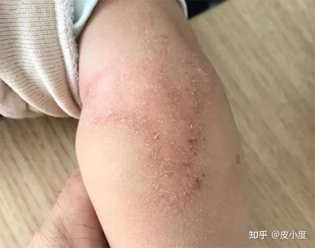 猫主子得了猫藓 铲屎官竟然进了医院 知乎