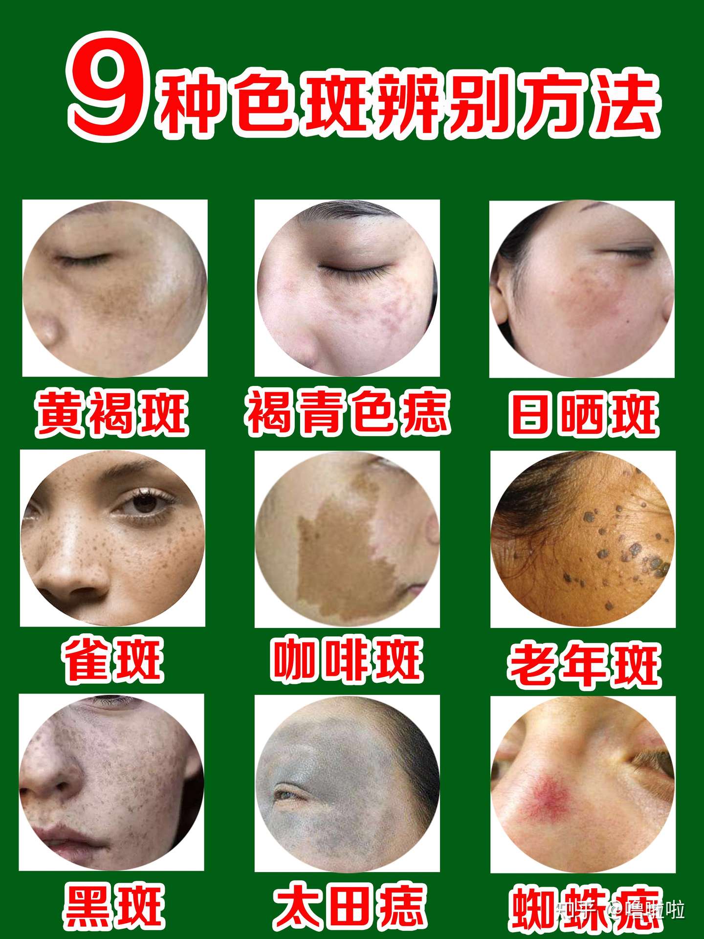 祛斑常识 9种常见色斑辨别方法 知乎