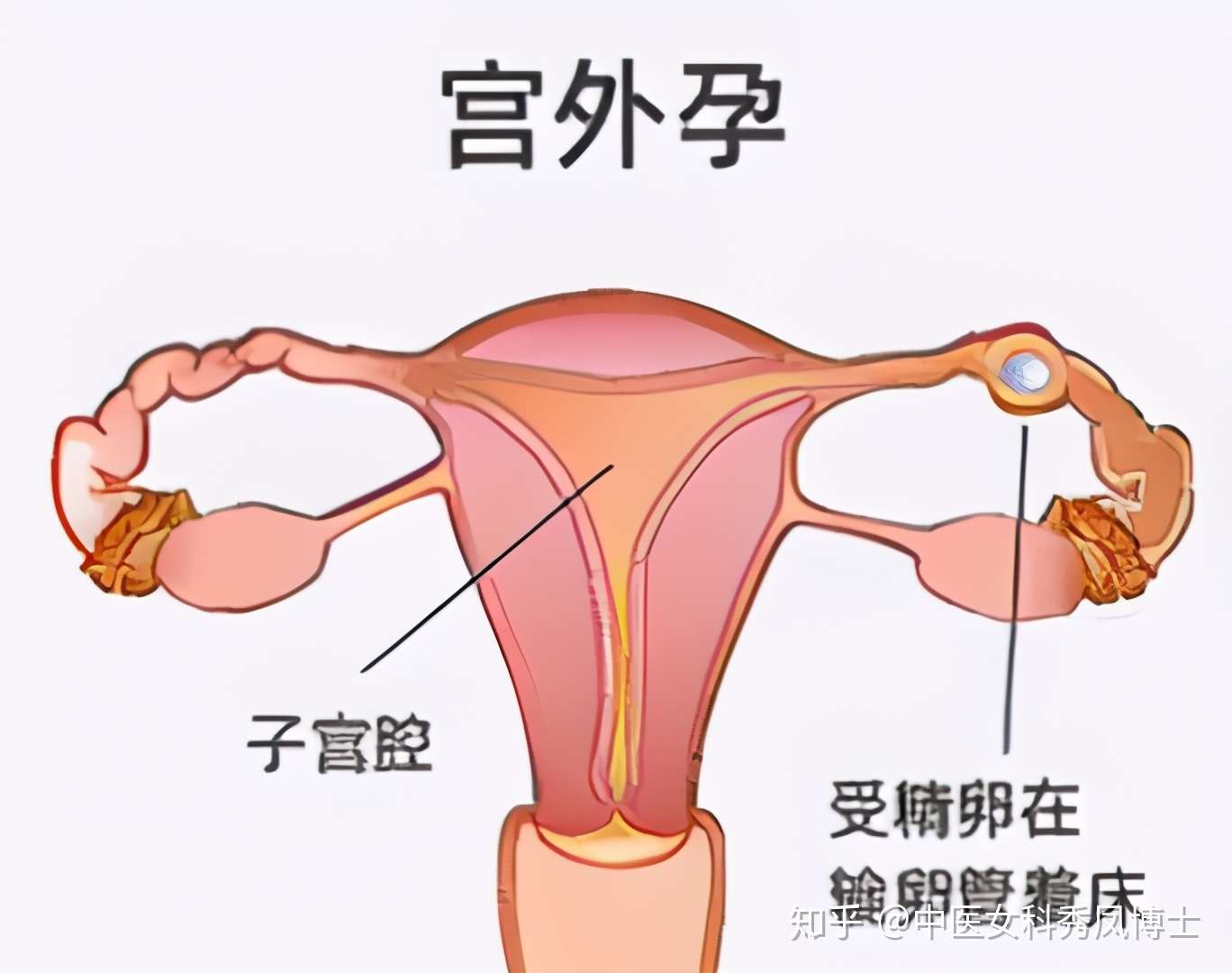 初期宫外孕的3大症状 知乎