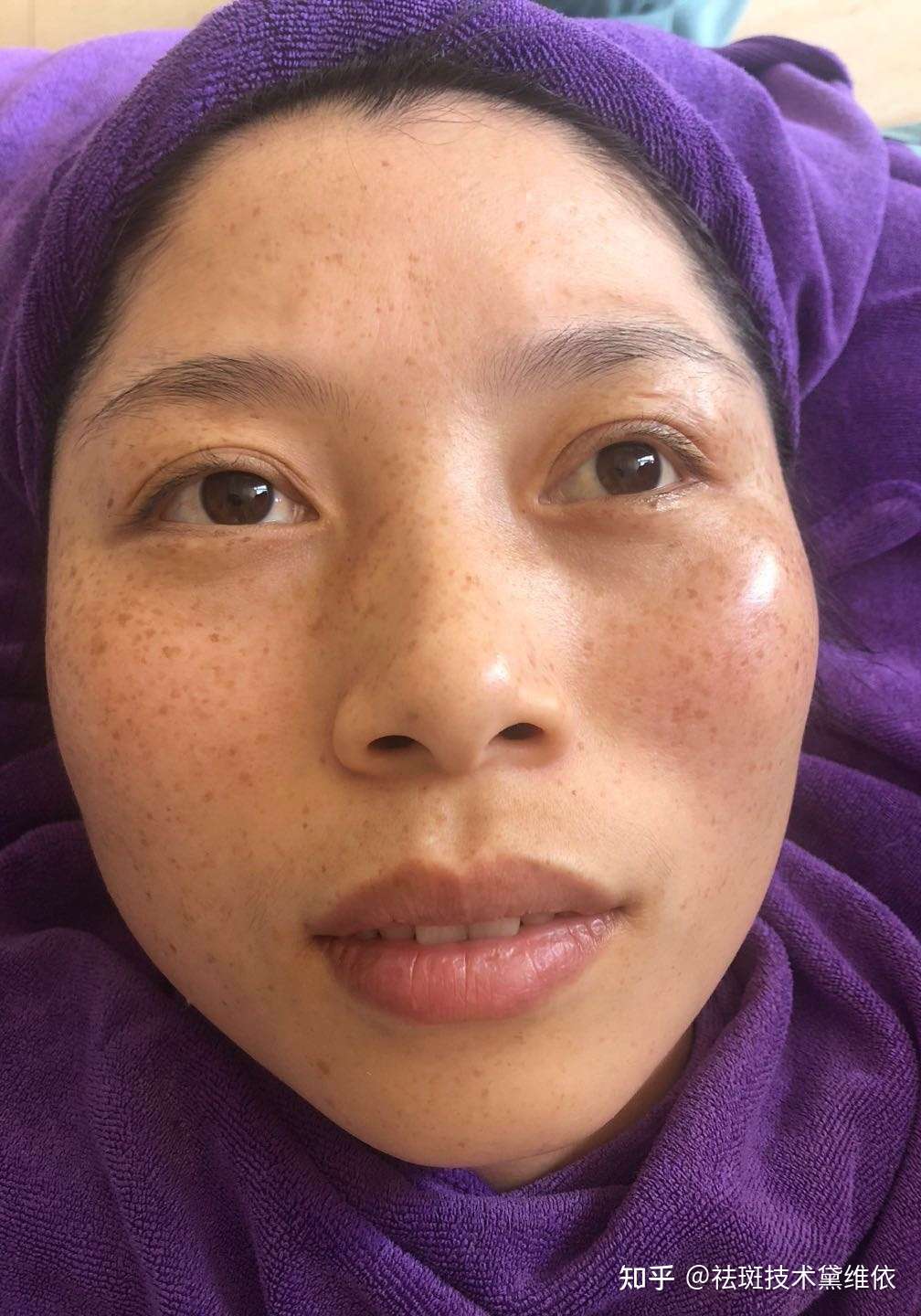 亚太名媛魅姬丽颜做祛斑用的是药水点斑方法