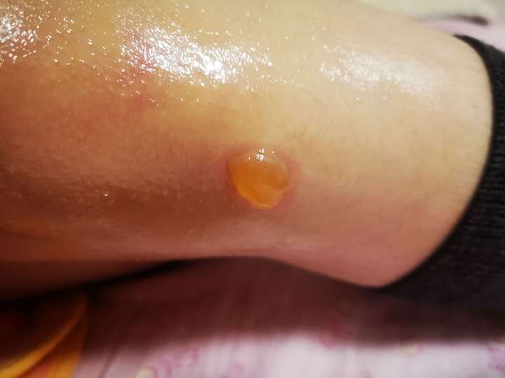 睡着时被热水袋烫伤一小块怎么解决