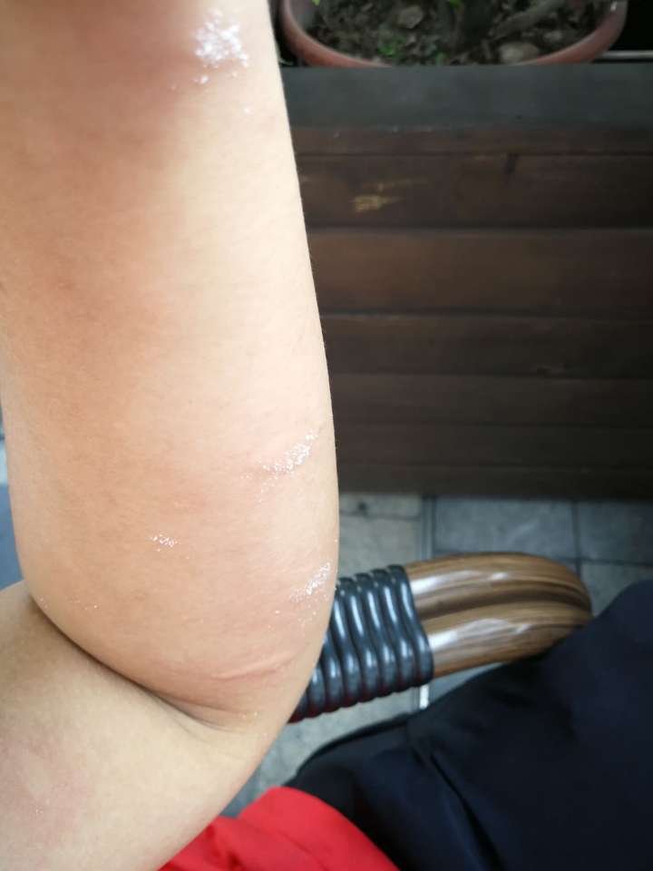 蠓,不少人深受其害,为何没能得到医学重视?