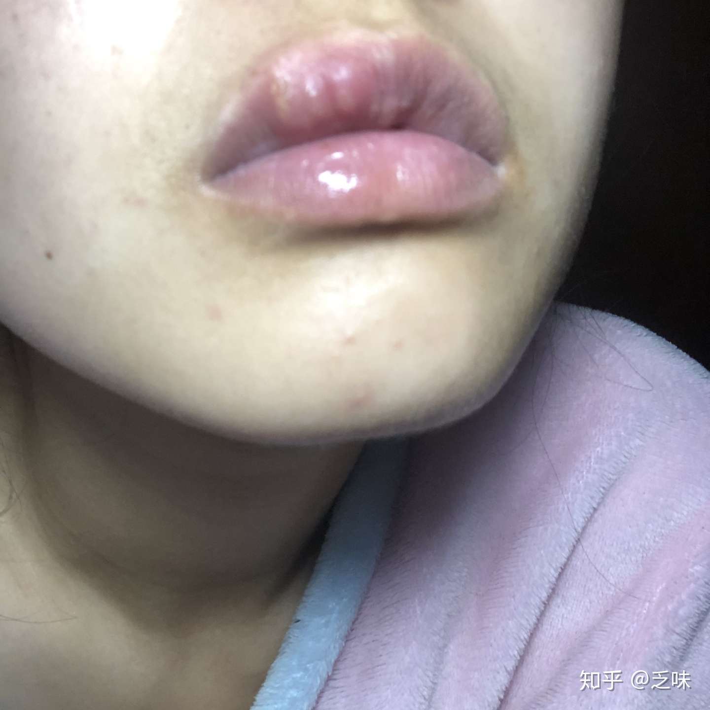 嘴上起泡的小建议 有图 慎点 知乎