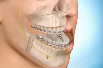 必须纠正!兜齿有损容貌及自信,但不必然引起健康问题