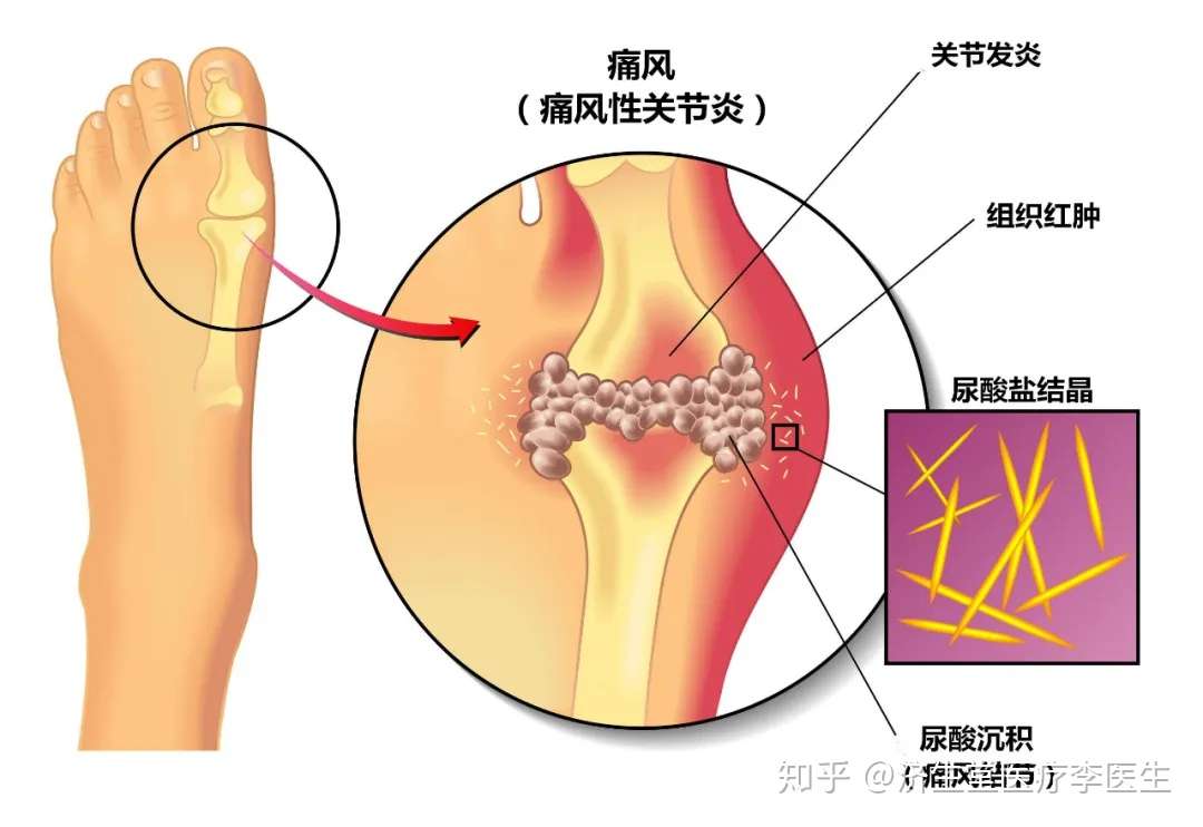 原因 痛風