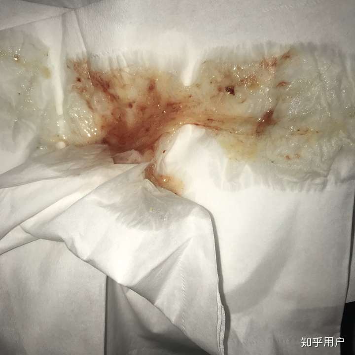 每天早上起床后喉咙经常性出血,一定是慢性咽喉炎么?