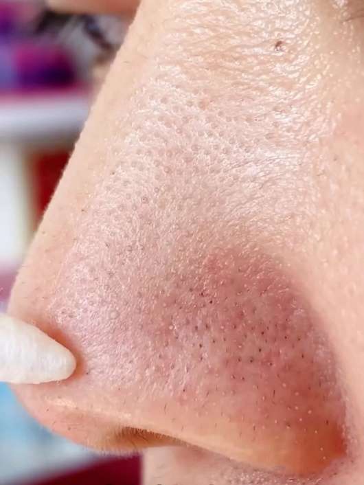 这样的黑头算严重么