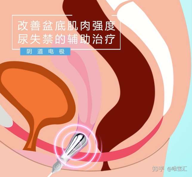 盆底肌电刺激治疗的原理 知乎