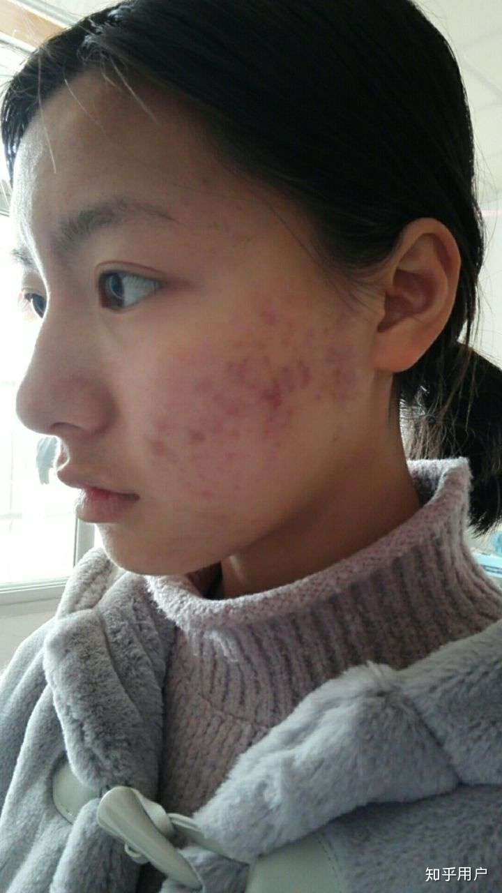 你们的痘印痘坑都是怎么好起来的