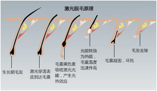 一篇文章搞懂激光脱毛 知乎