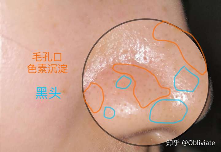 是 黑头    毛孔色素沉淀的混合.