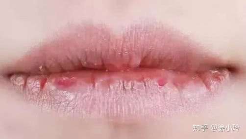 冬季嘴唇发干怎么办 知乎