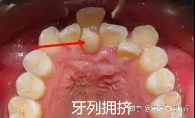 牙列拥挤是什么有什么危害