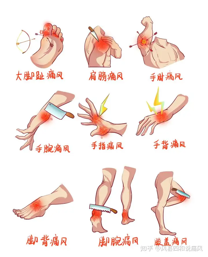 一分钟自测：3个方法测试痛风-自己如何测试