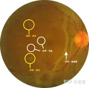 硬性滲出有時可自行吸收,但過 程較緩慢,在眼底上可存在數月或數年