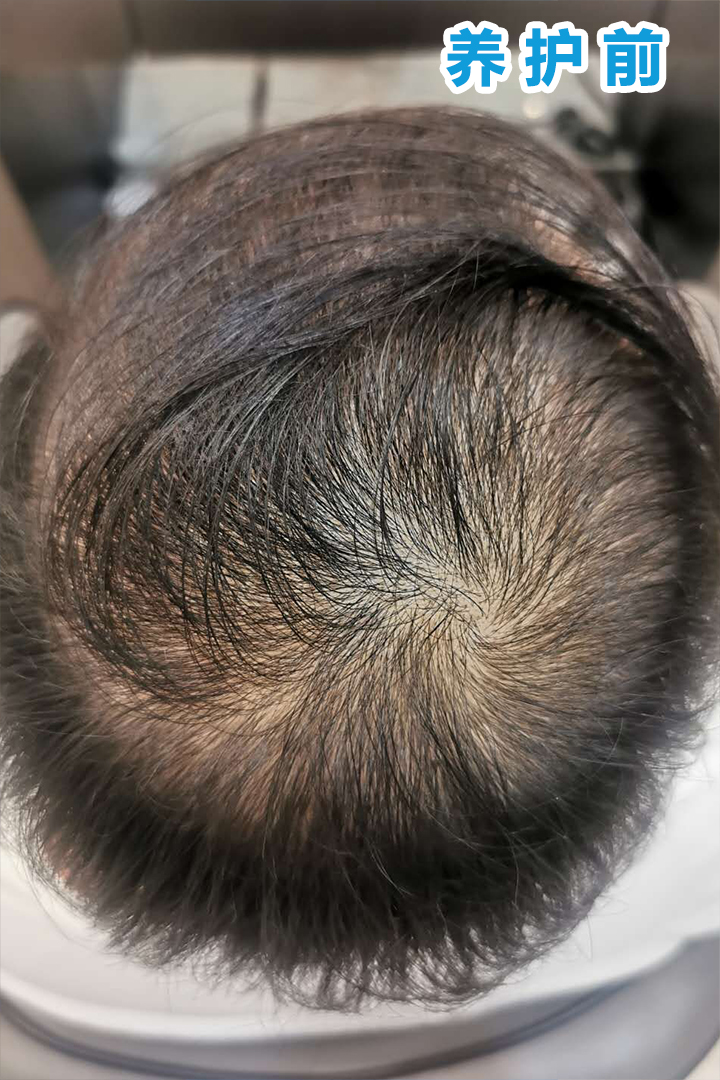 小兄弟头顶稀疏说影响形象5个月前我给他做了中胚层医学养护现在恢复