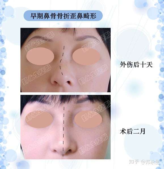 鼻子歪成c型怎么办 C型歪鼻手术注意技巧 知乎