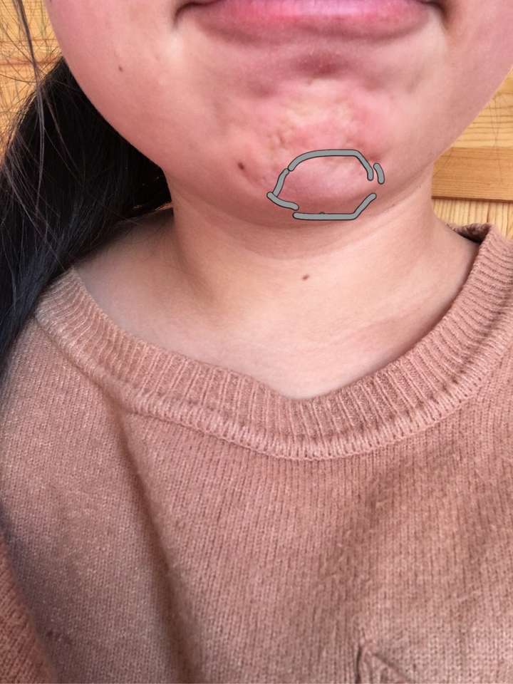 玻尿酸注射三年半一年恢复了以为吸收完了不疼不痒没硬块最近喉咙肿的