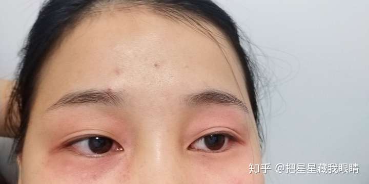 用雅诗兰黛小棕瓶眼霜和精华过敏!