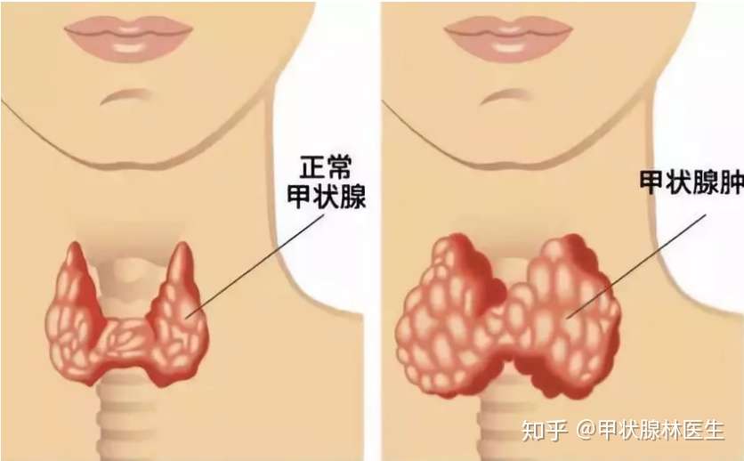 关于甲状腺肿大 这几点常识你一定要知道 知乎